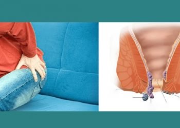 Finding Safe and Effective Treatment for Piles