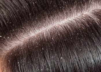 How To Get Rid Of Dandruff: Winter Care Solution