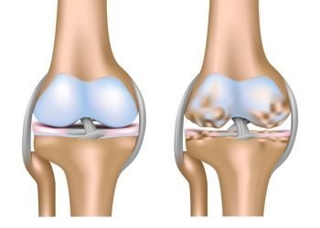 Treating Osteoarthritis at Home