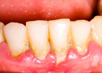 Keeping up With Solid Teeth and Gums With Legitimate Oral Consideration is a Long-lasting Responsibility