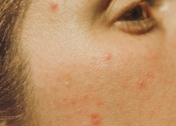 ​​7 Tips for Combining Sunscreen With Your Acne Meds