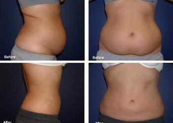 What is Laser-assisted Liposuction?