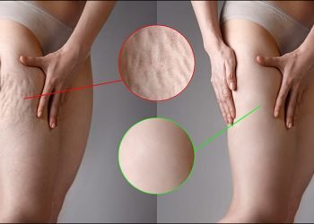 All You Need To Know About Cellulite Treatment