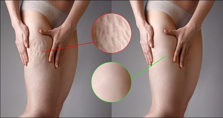 All You Need To Know About Cellulite Treatment