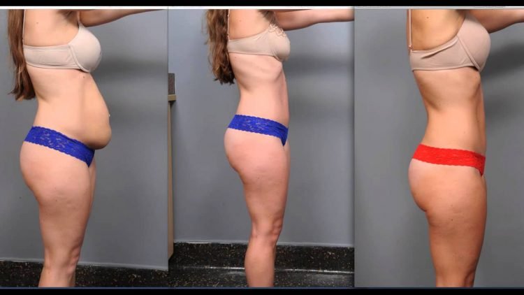 Planning your Tummy Tuck Recovery the Right Way