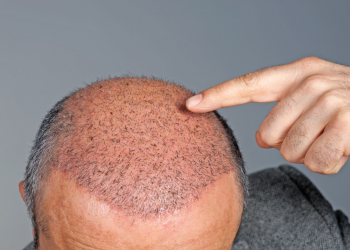 Hair transplant treatment in Thane: Learn everything about it