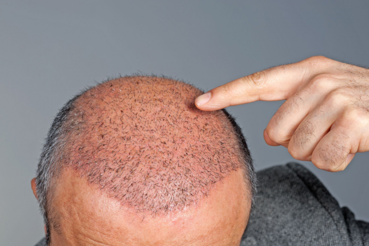 Hair transplant treatment in Thane: Learn everything about it