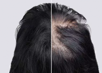 Is it possible for obesity to cause hair loss?