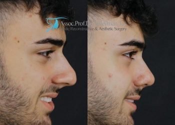 Swelling, Bruising & Edema After Rhinoplasty