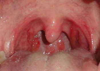 10 Home Remedies for a Sore Throat