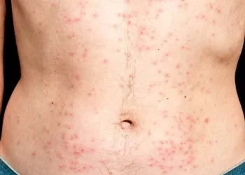 How to Protect Your Skin from Chlorine and Saltwater