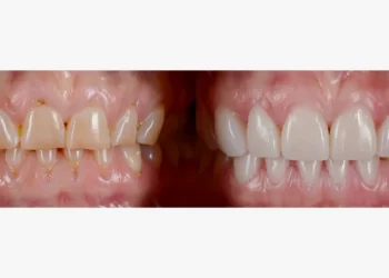 Teeth Veneers Cost: How Much Does it Cost to Have Veneers