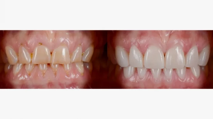 Teeth Veneers Cost: How Much Does it Cost to Have Veneers