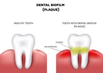 DENTAL BIOFILM: WHAT IS IT, AND HOW IS IT PREVENTED?