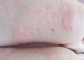 Having sensitive skin can be challenging. You are likely to have red, itchy patches