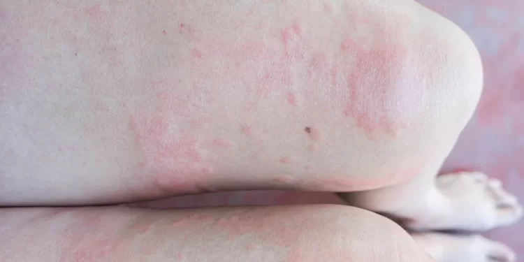 Having sensitive skin can be challenging. You are likely to have red, itchy patches