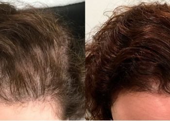 Why Choose PRF Treatment