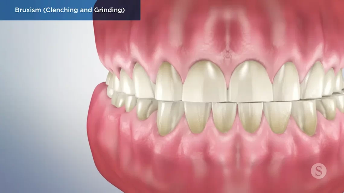 Answering FAQs About Ordering Online Custom Night Guards