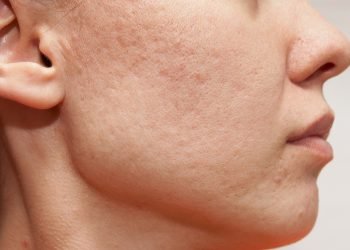 At-Home Remedies for Blemishes