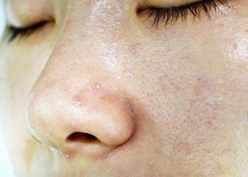 How to Treat and Prevent Acne On Oily Skin