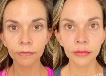 Balancing Facial Proportions with Fillers and Injectables