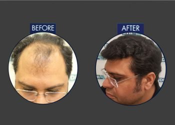 How Long is the DHI Hair Transplant Surgery?