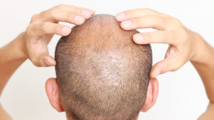 Navigating Life Beyond the First Year of Your Hair Transplant