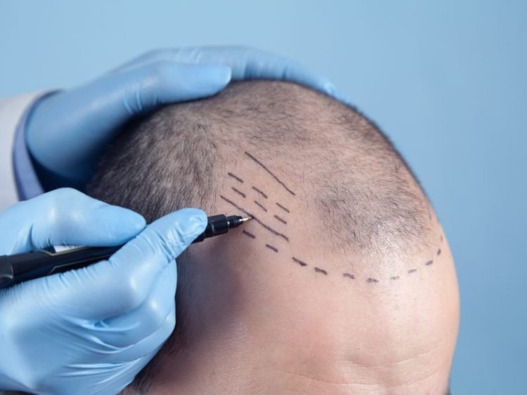 Turkey Hair Transplant Cost in 2024 Revealed