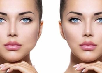 Everything about Buccal Fat Removal (Bichectomy)