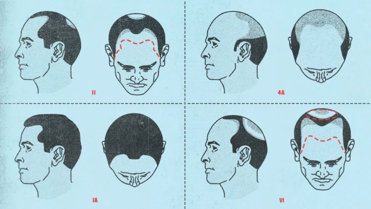 Combating Hair Loss Stigma: How Turkey’s Transplant Industry is Changing Perceptions