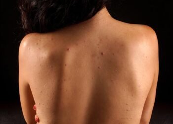 Back Acne: Causes and Treatments