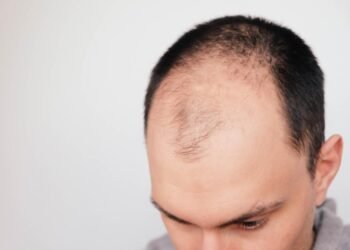 Understanding the Norwood Scale: Stages of Male Pattern Baldness