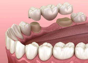 The Best Dental Bridge Options for Missing Teeth in Waco