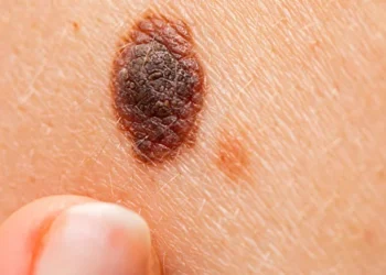 Signs of Skin Cancer You Need to Know