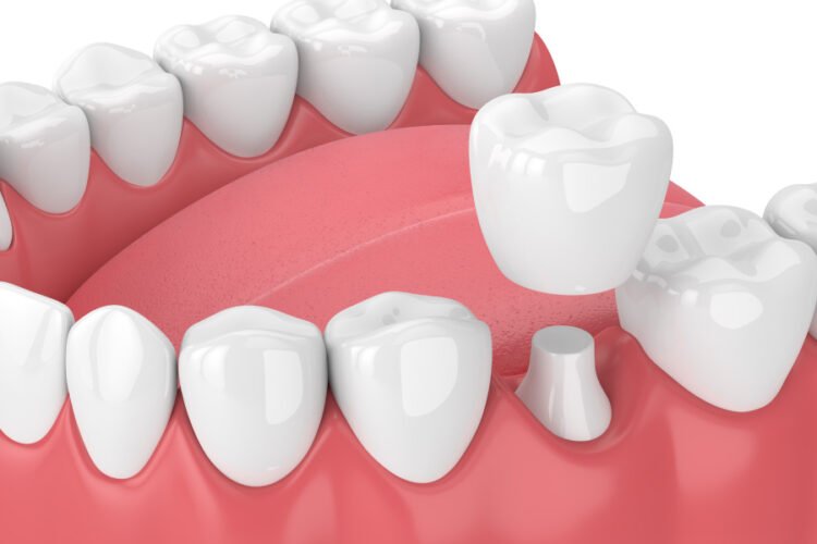 How CEREC is Streamlining Dental Crown Creation