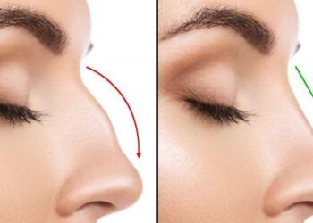 Rhinoplasty in Turkey: A Global Hub for Aesthetic Transformations