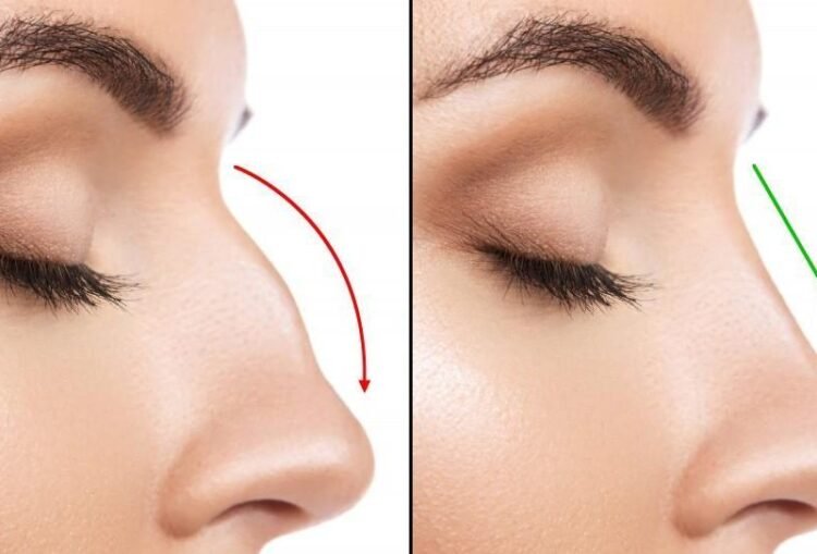 Rhinoplasty in Turkey: A Global Hub for Aesthetic Transformations